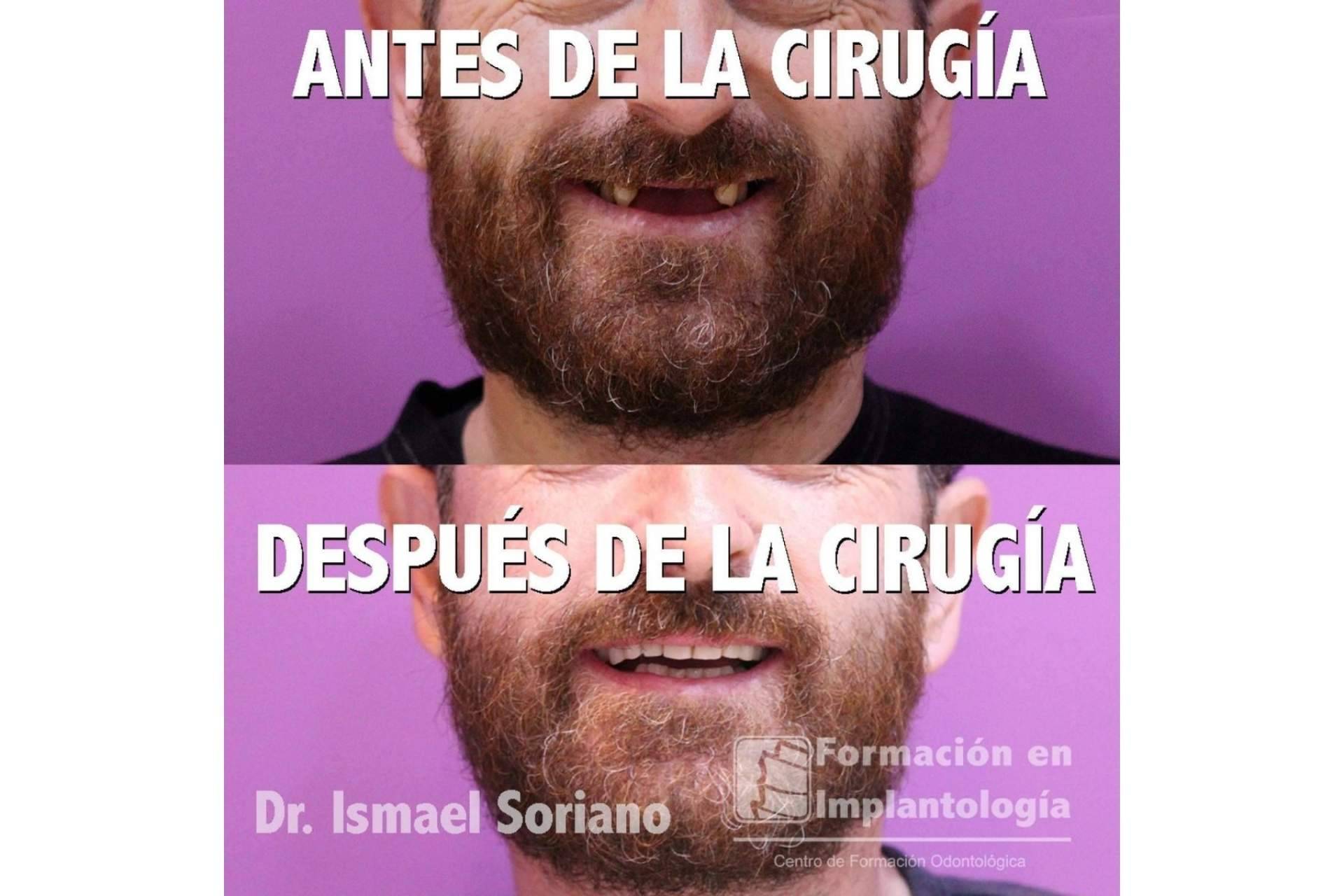 Implantes con dientes inmediatos, la técnica del Dr. Ismael Soriano que ofrece múltiples ventajas a los pacientes