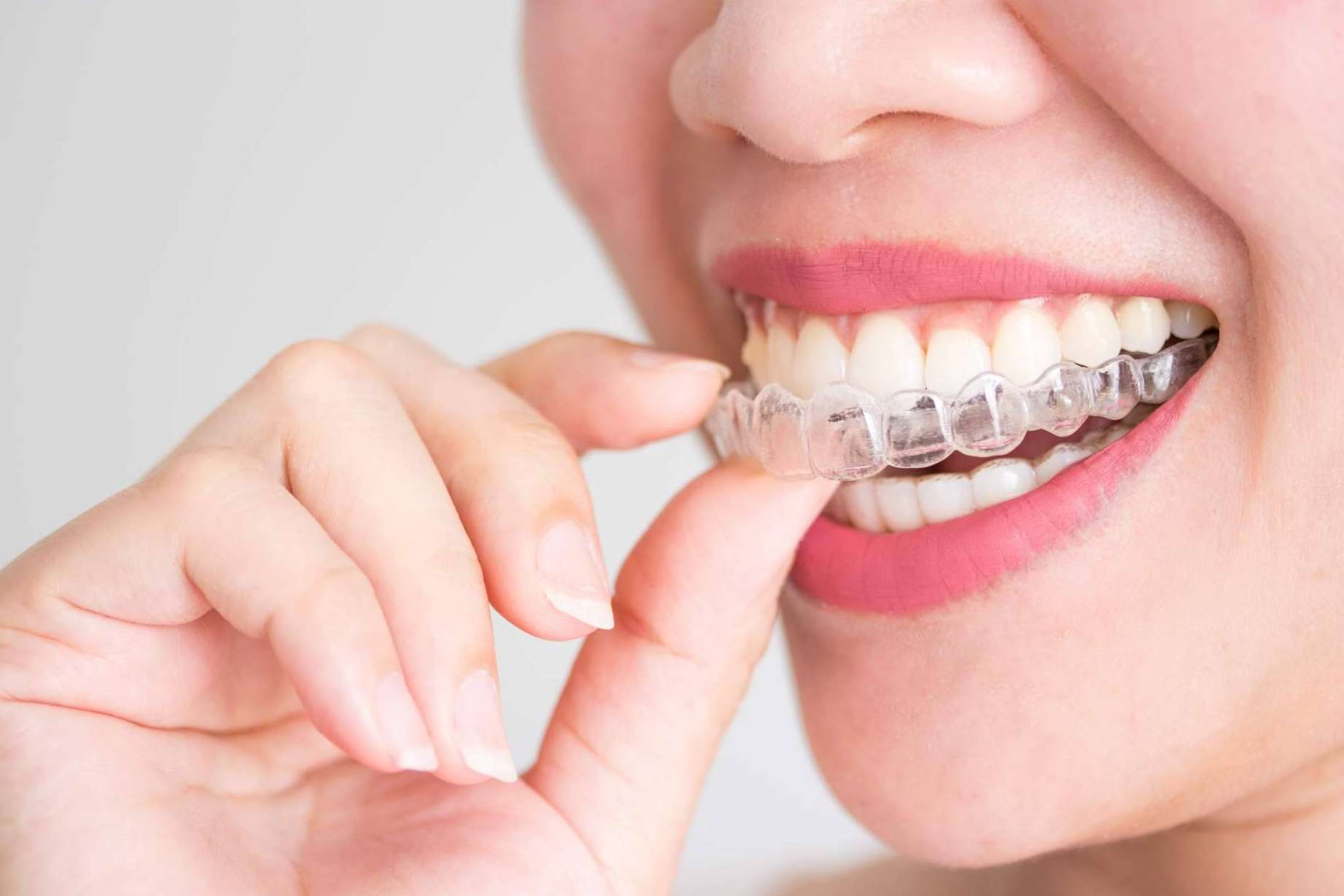 ¿Para qué sirve un tratamiento de ortodoncia con brackets? Helident Clínica Dental
