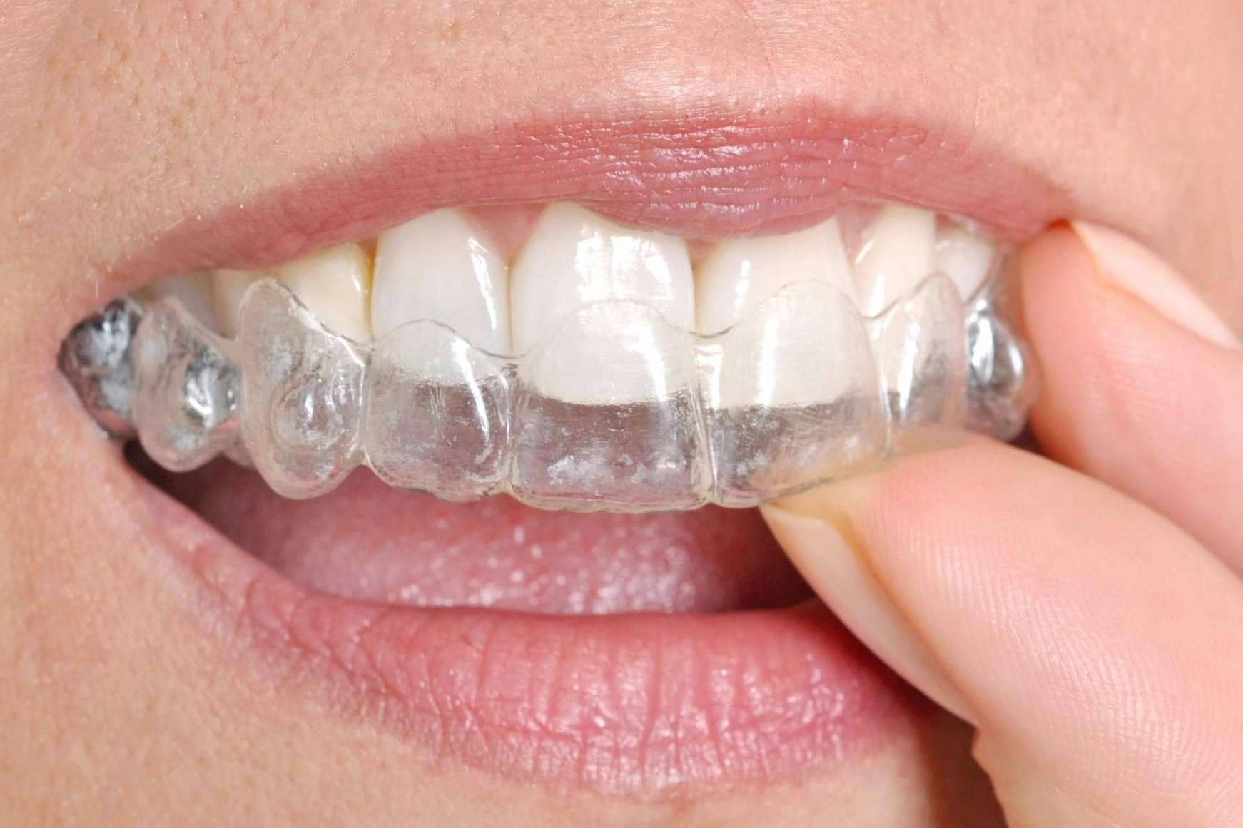 Los centros con el Certificado de Calidad DentalQuality® son recomendados y disponen de servicios de ortodoncia invisible