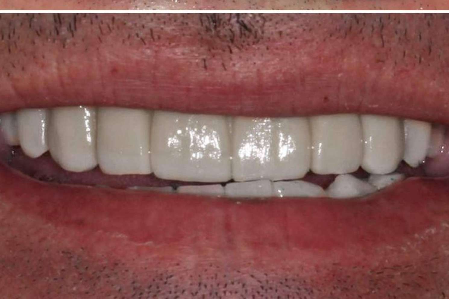 El tratamiento ALL ON 4 de Implant Clinics ¿Cuáles son sus beneficios?
