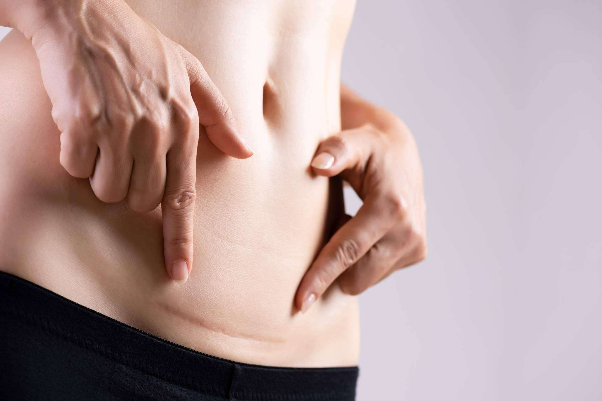 ¿Por qué es importante la fisioterapia y la osteopatía en el tratamiento de cicatrices y liberación de adherencias?