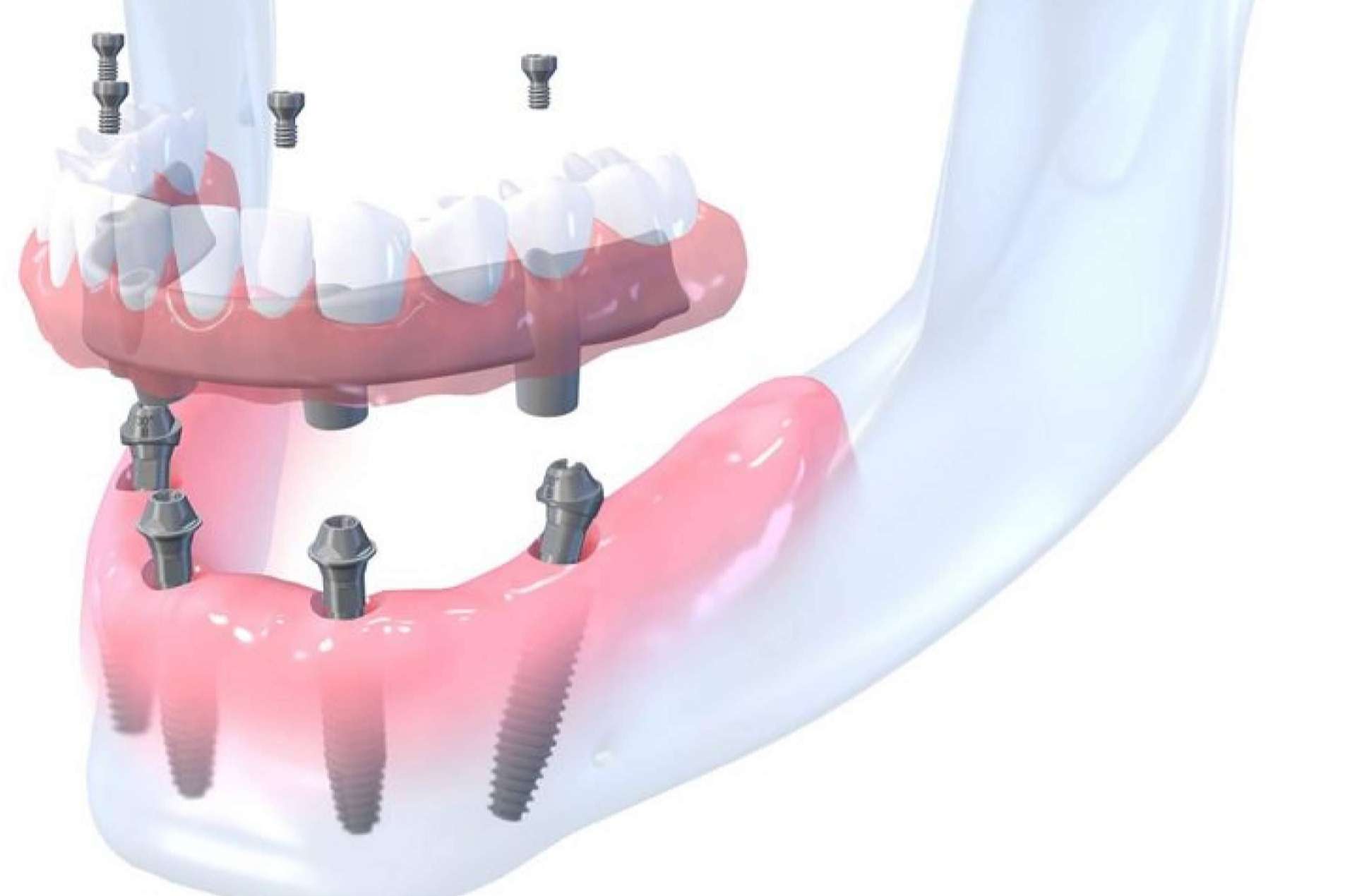 Rehabilitaciones orales complejas en un día en la clínica dental en Madrid Bordonclinic
