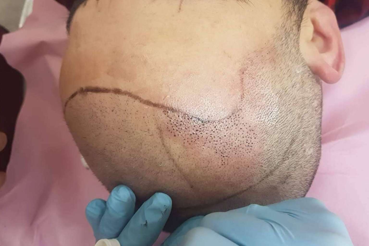 Los profesionales de la micropigmentación pueden ampliar sus conocimientos y aprender técnicas de micropigmentación capilar de la mano del centro VG Virginia Gómez