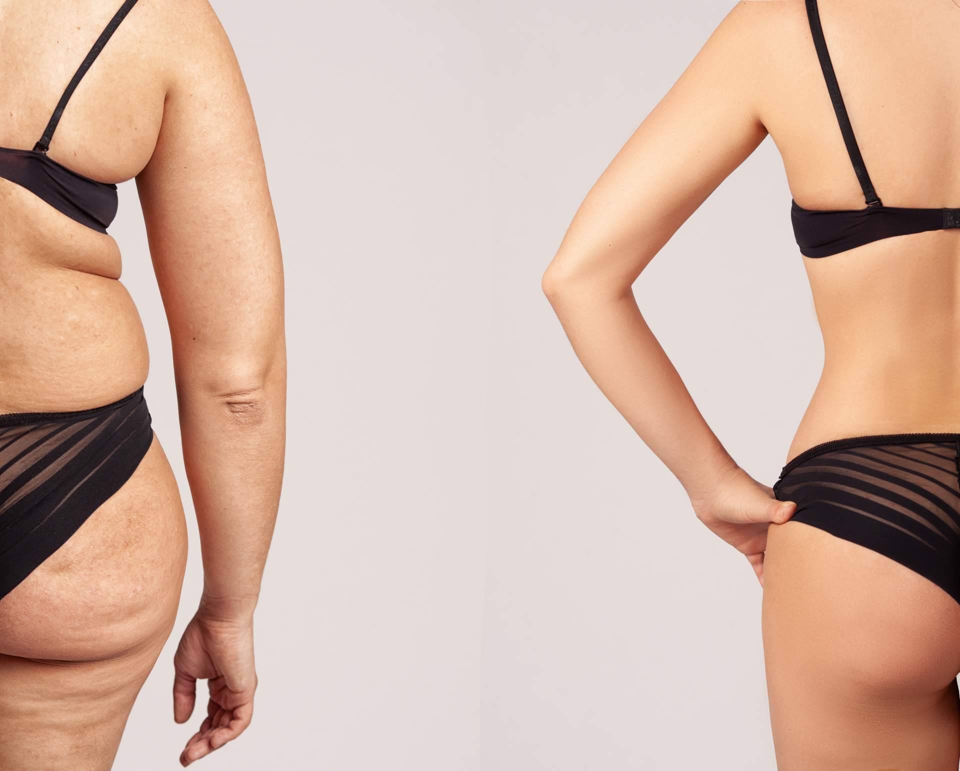Los efectos del tratamiento de Velashape III de la Dra. Rigo