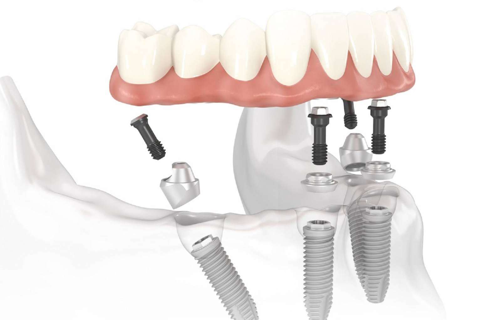 Dentinova realiza implantes dentales en un día con su tecnología digital
