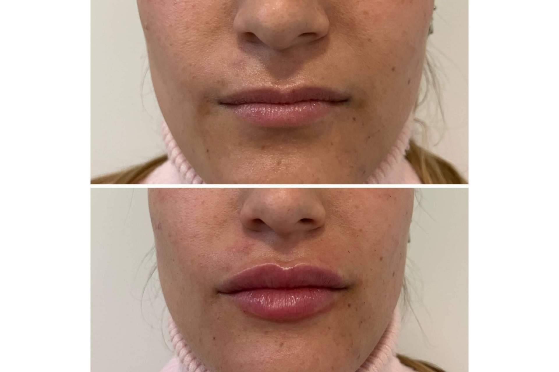 ¿Es posible realizarse un aumento de labios en Madrid con resultados naturales?, por la Dra. Cecilia Arthur