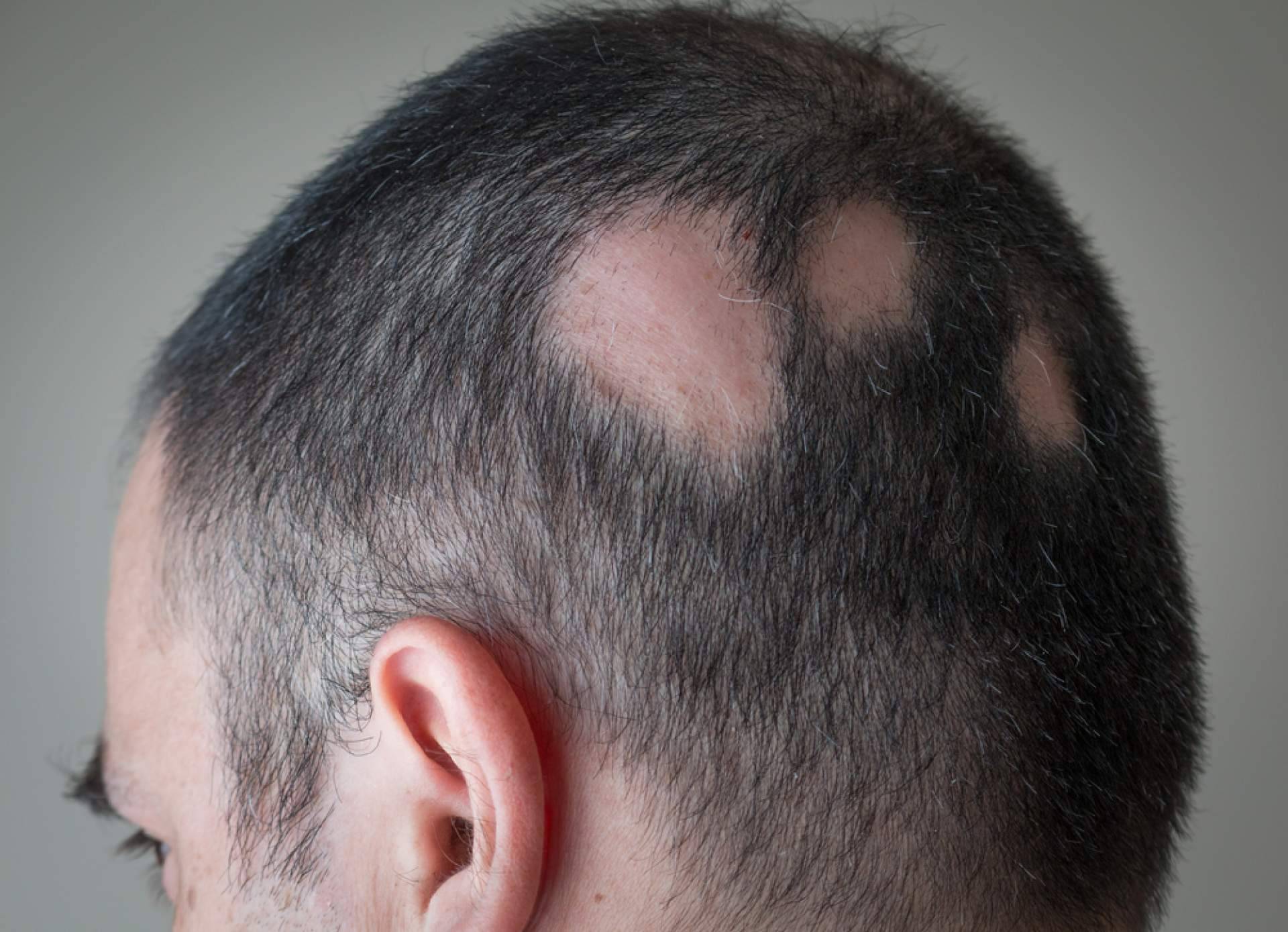 En qué consiste la alopecia areata y cómo disminuirla