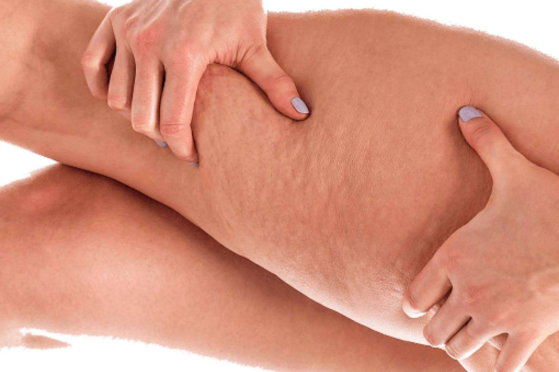 Identificar el nivel de la celulitis para determinar los procesos y terapias acertadas, con los sensores especiales de Soluciones