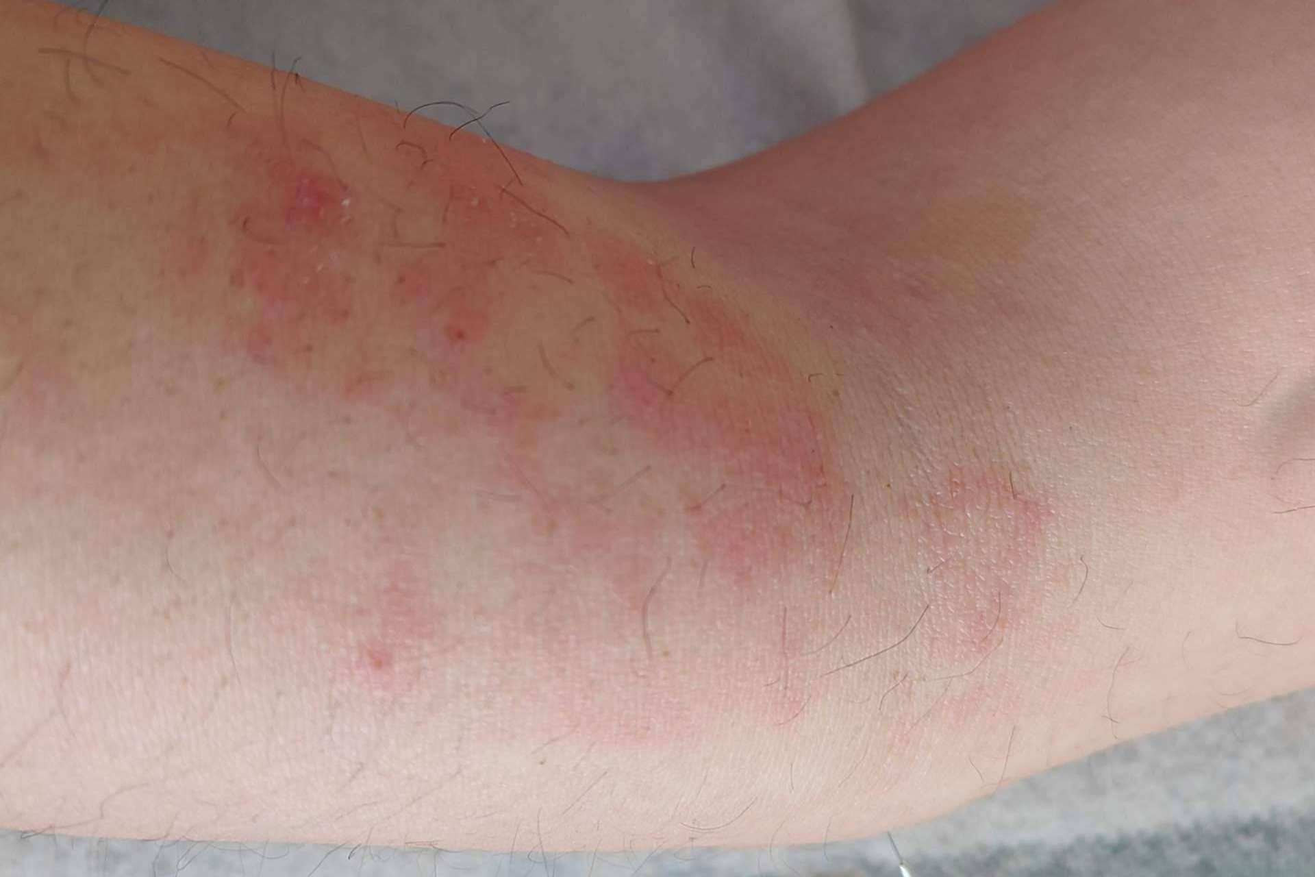 Tratando los problemas de la piel a través de la acupuntura y fototerapia, de la mano de Nüwa