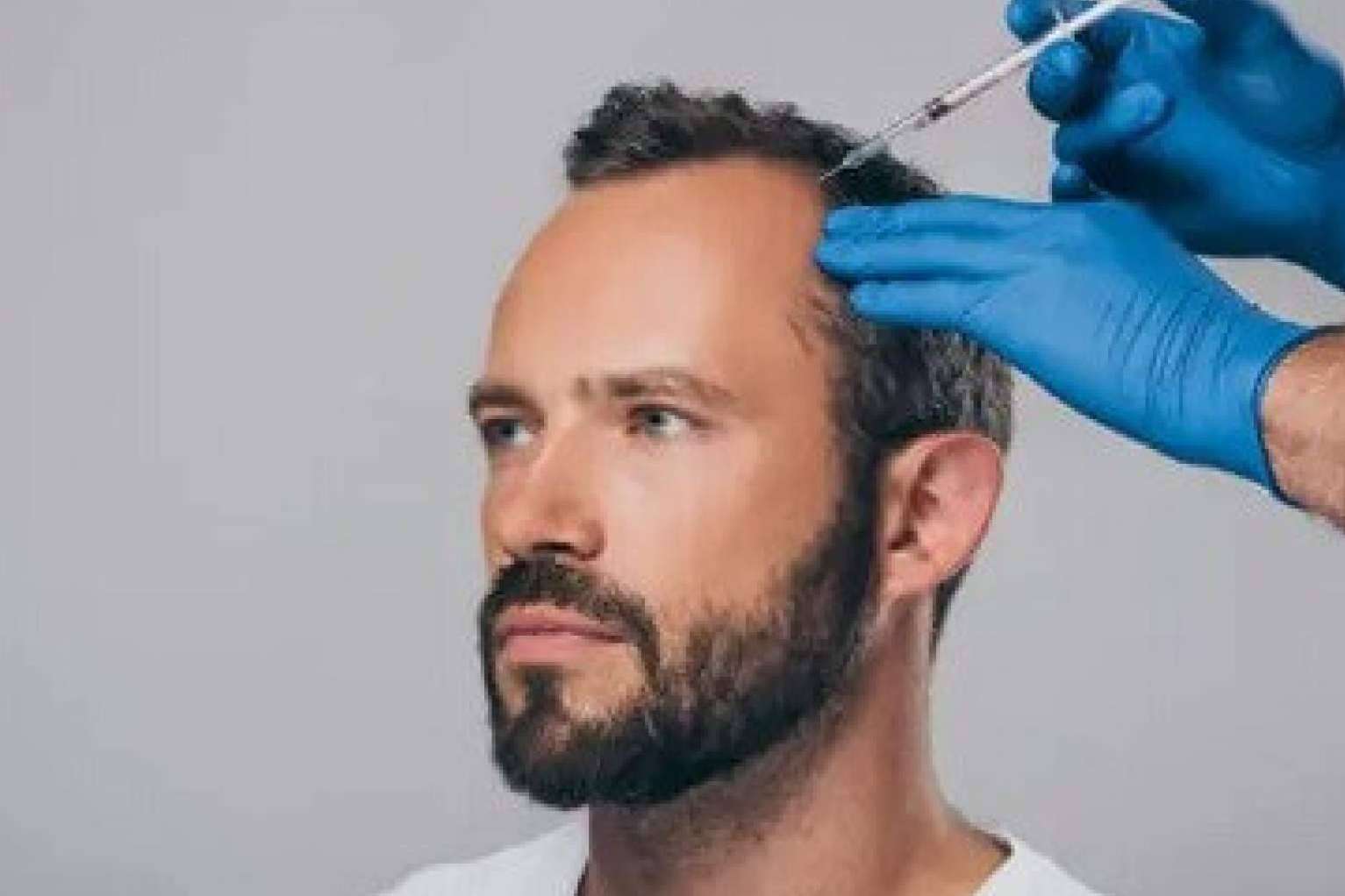Un tratamiento para la caída del pelo, la mesoterapia capilar