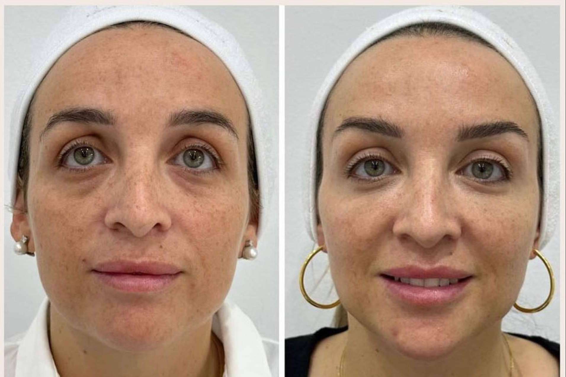 Clínica VISO sobre cómo combatir la flacidez facial