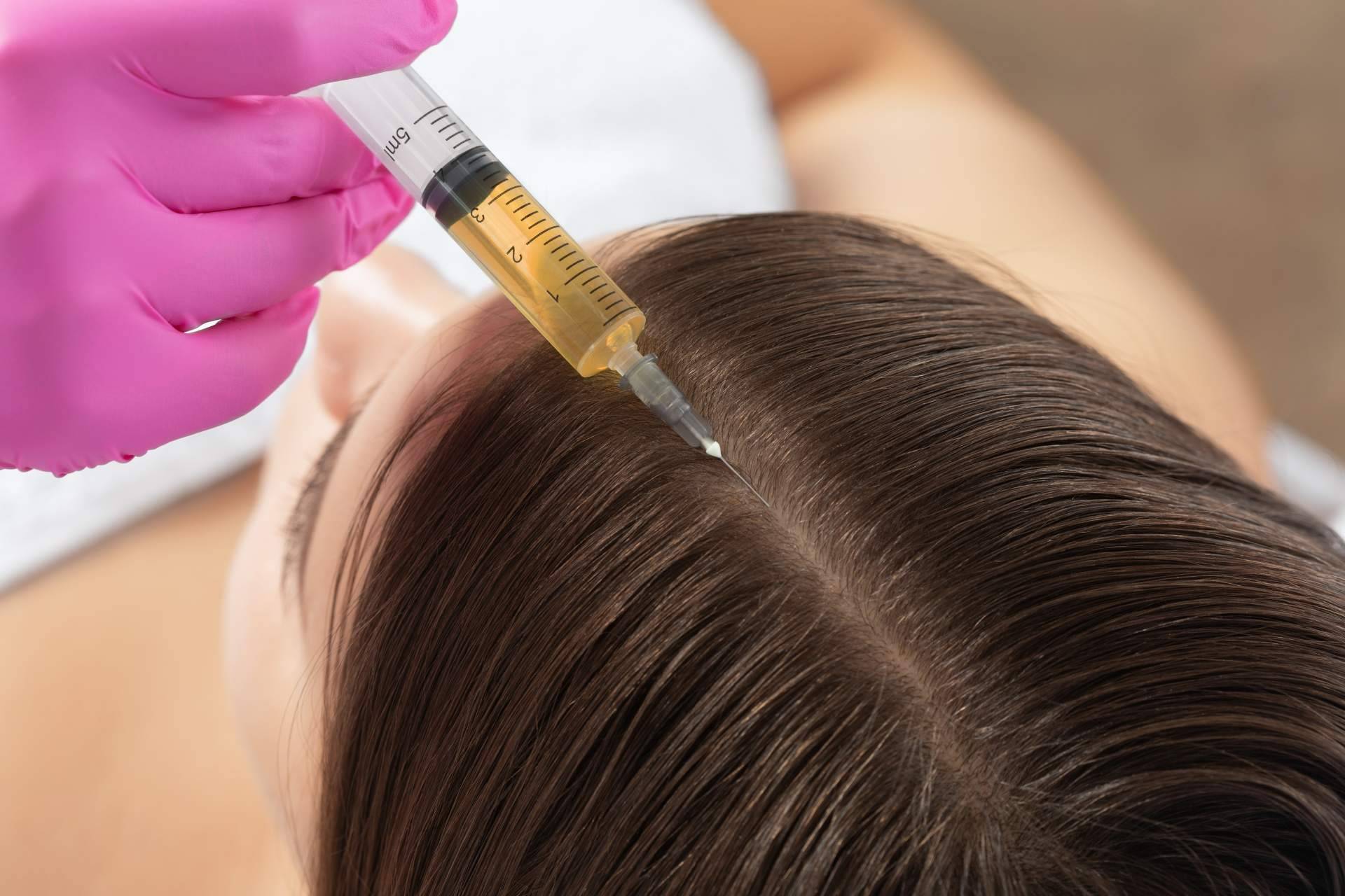 Recuperar la densidad capilar perdida gracias a los tratamientos especializados de MC360 para la alopecia difusa