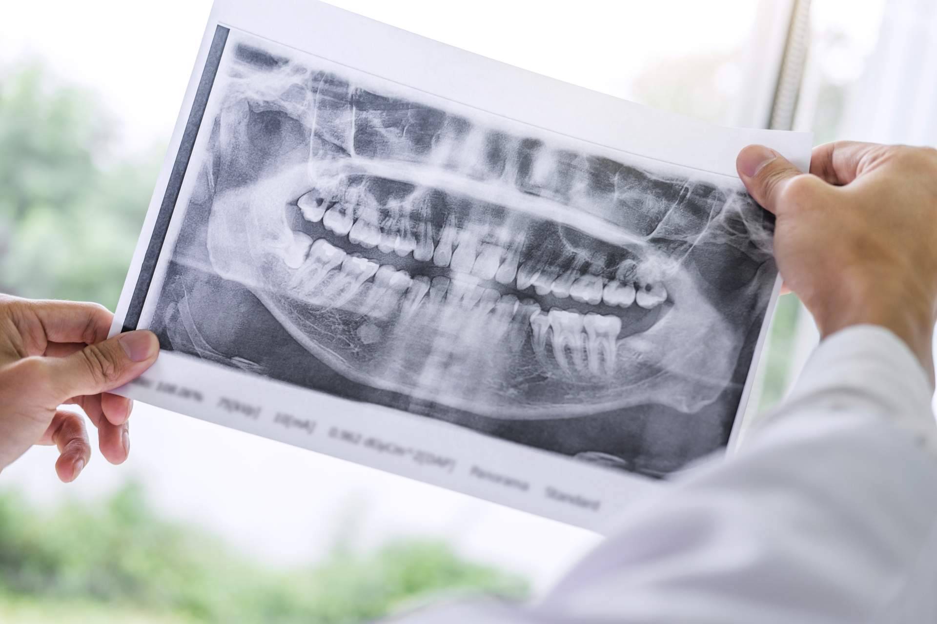 10 razones para acudir a un cirujano maxilofacial para problemas bucales