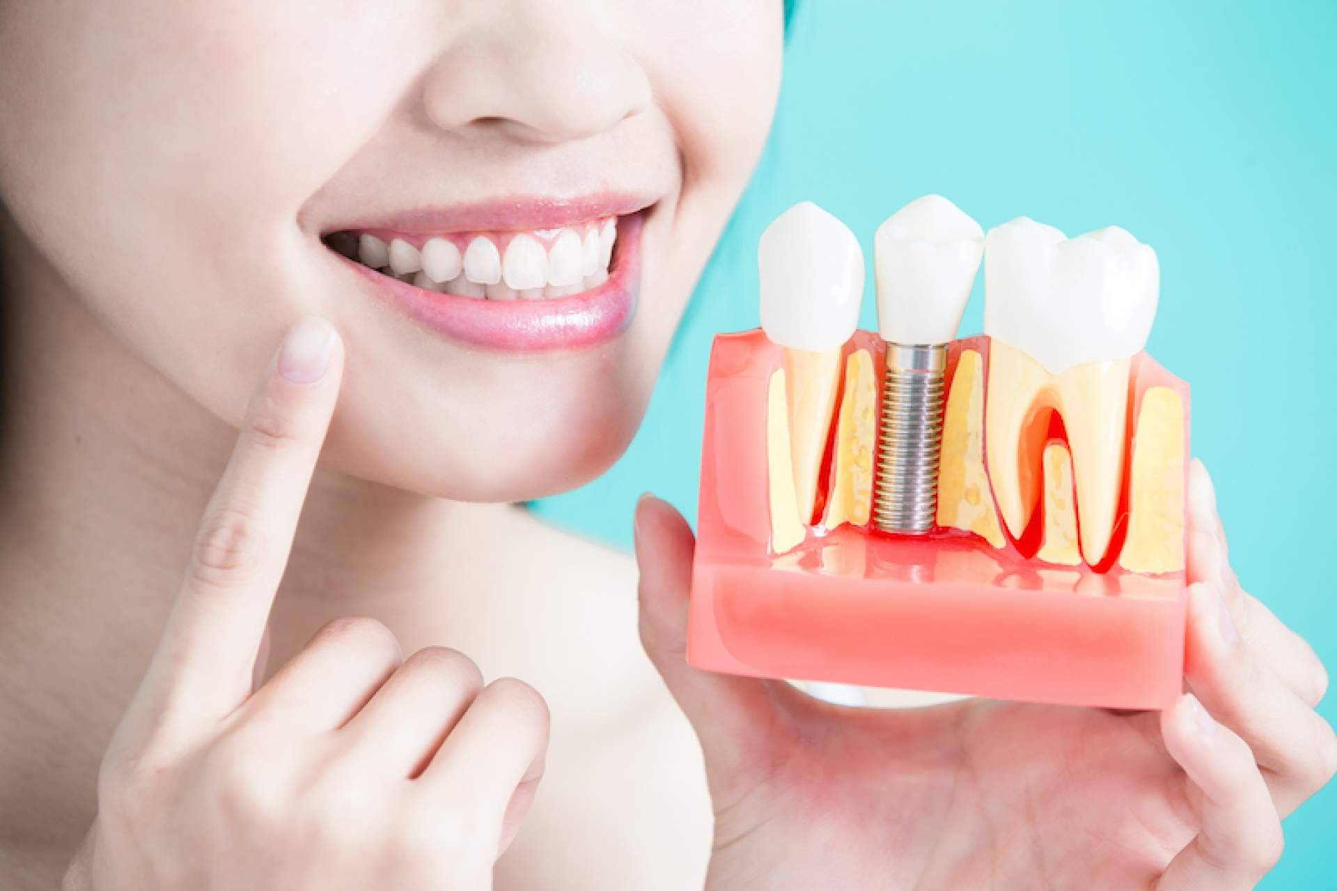 Implantes a medida con materiales de calidad en la clínica dental Samprodent; una solución personalizada para cada paciente