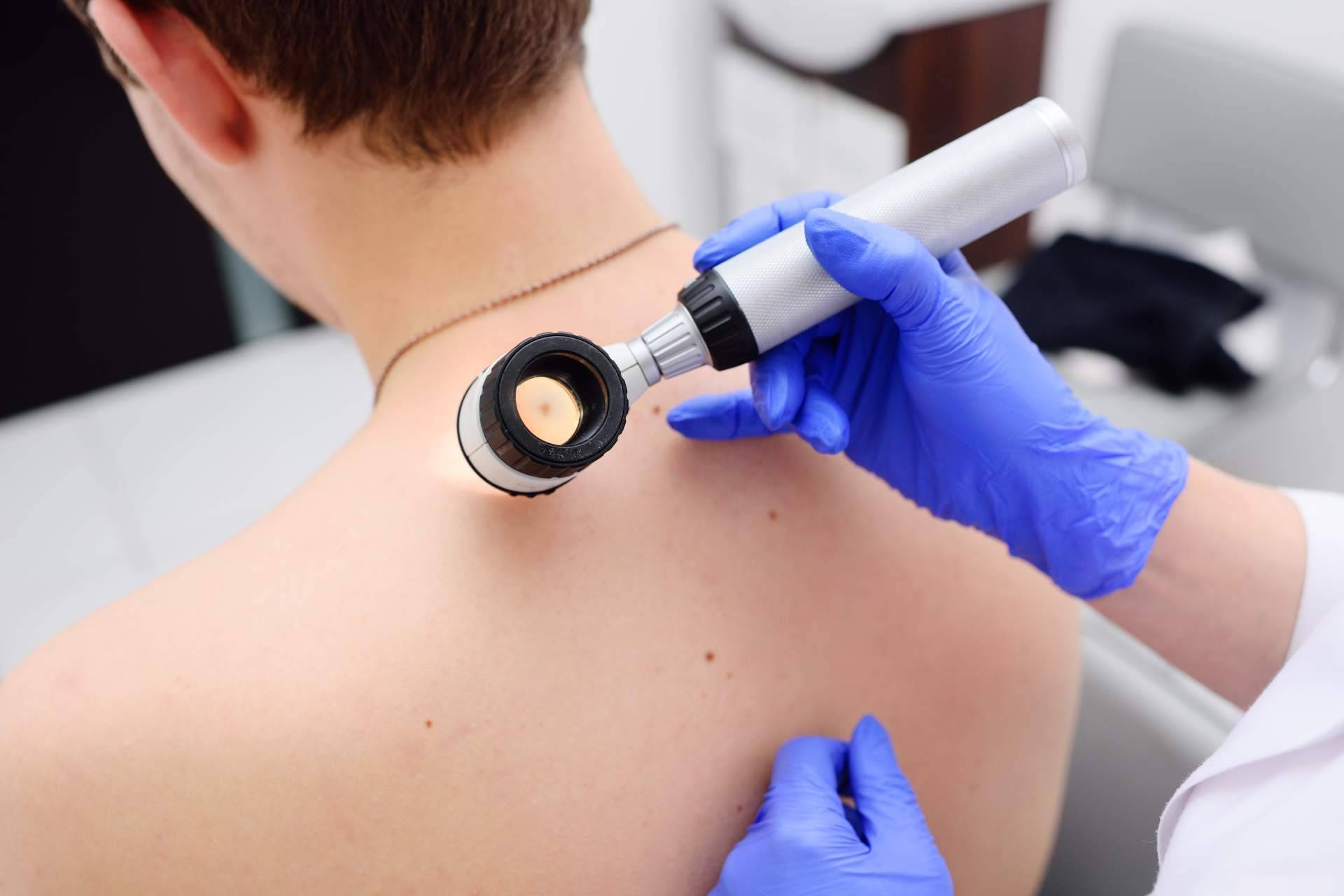 Buenos hábitos al sol como medida de protección ante los melanomas