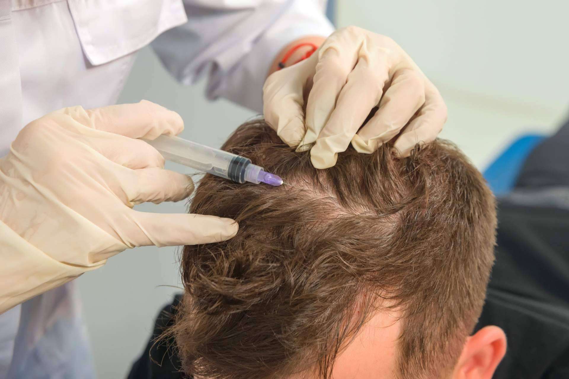 Ventajas de realizarse un tratamiento de mesoterapia capilar de IMD para recuperar las condiciones óptimas del cabello