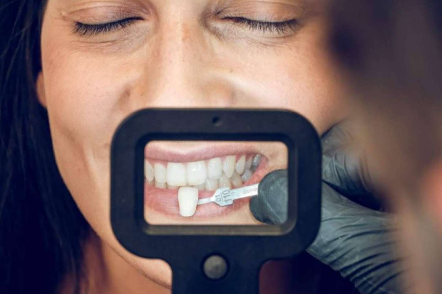 Los beneficios de las carillas de composite, por Clínica Dental Ruiz de Gopegui