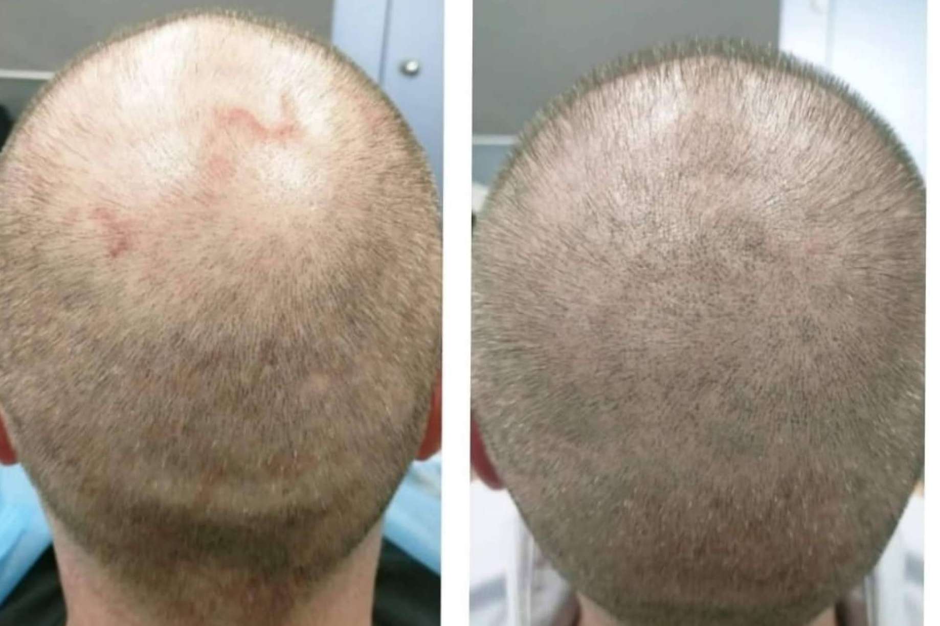 ¿Cuáles son los beneficios de la micropigmentación capilar?, por Dermopigmentación Clínica