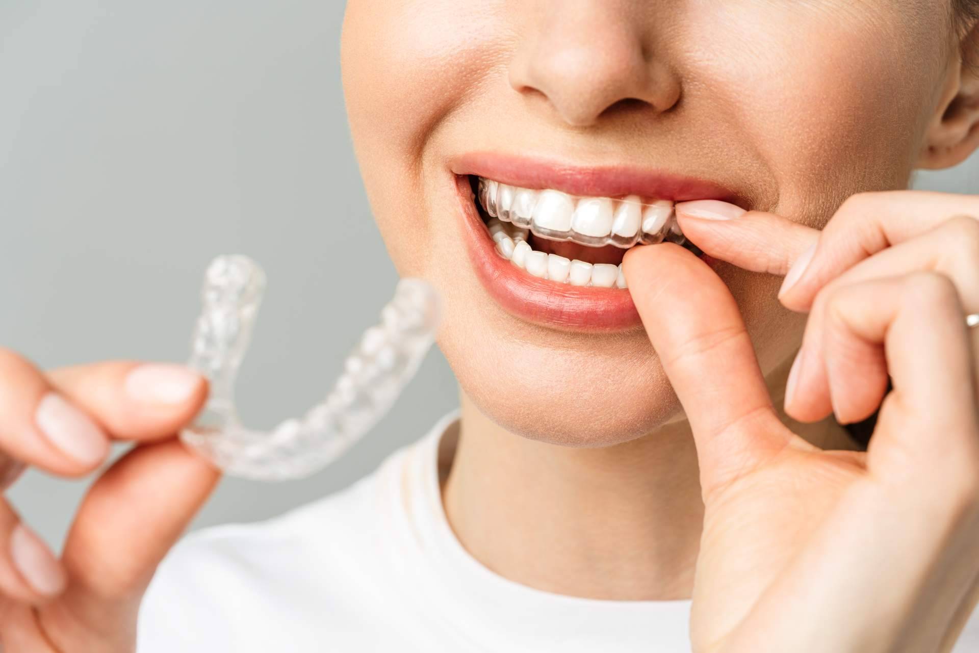 Tratamiento Invisalign a precios competitivos y resultados excepcionales con Clínica InterOralia