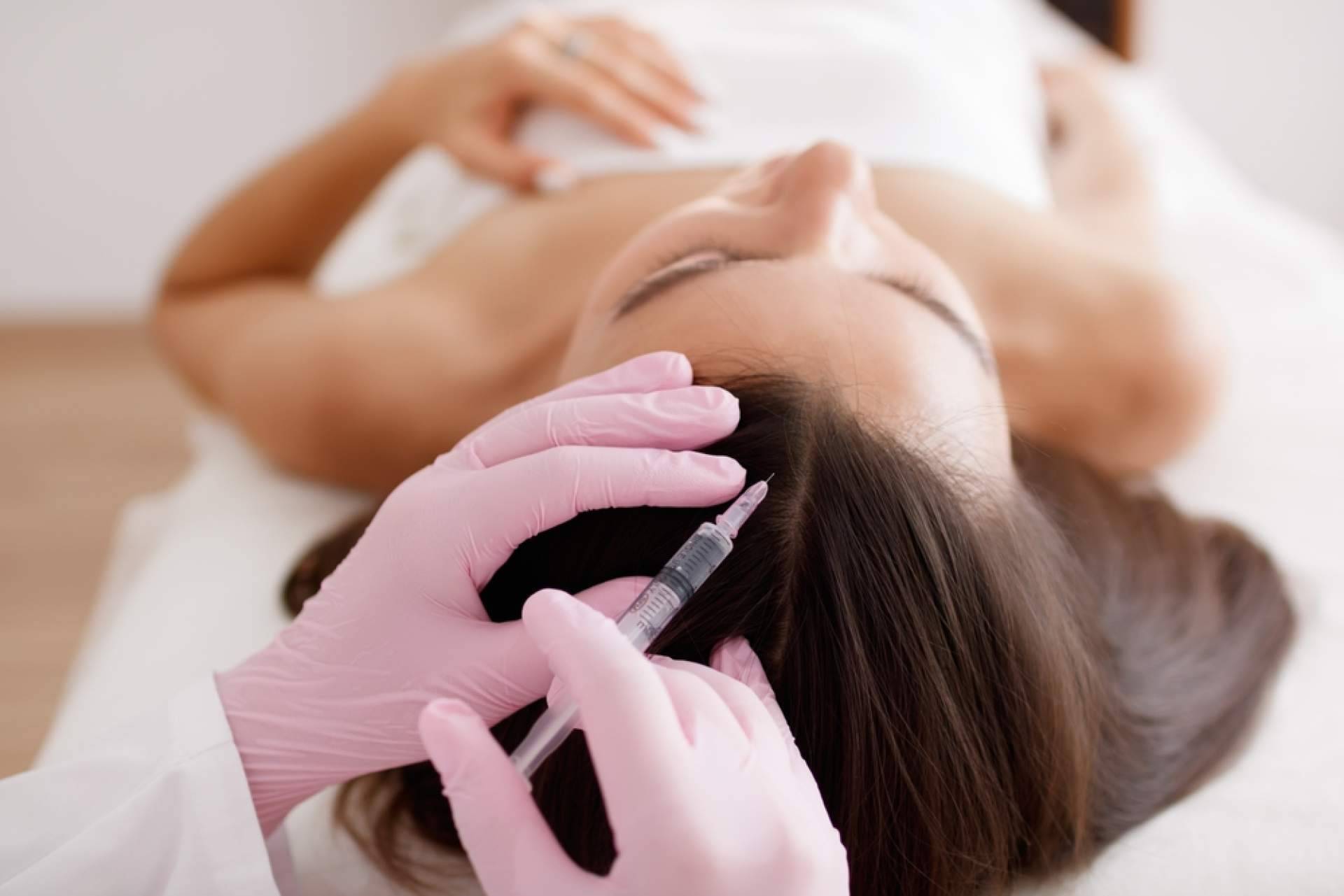 Combatir la caída del cabello con mesoterapia capilar, una terapia sin cirugía