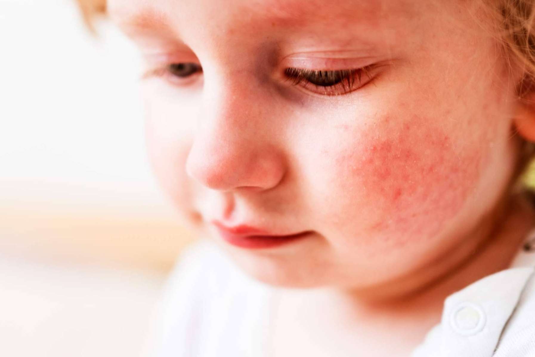 Novopiel, el superhéroe de los luchadores contra el eczema