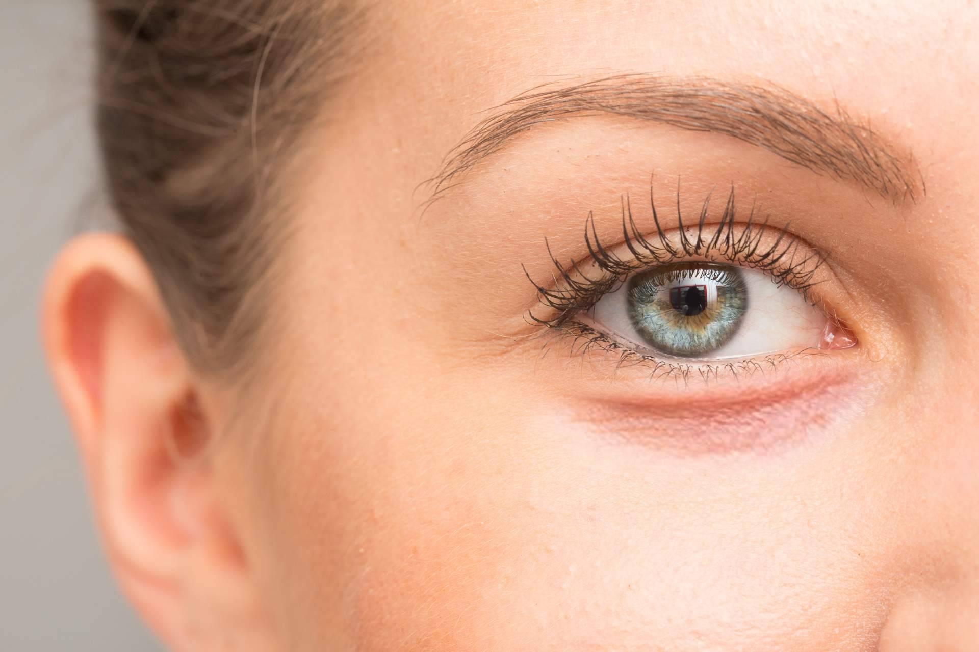 Eliminación de ojeras con ácido hialurónico, de la mano de Centro Médico El Pilar