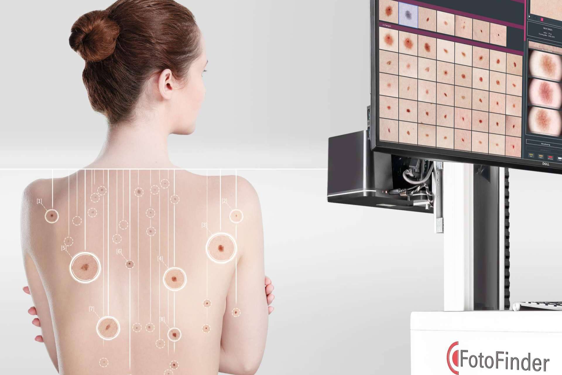 La tecnología con Inteligencia Artificial de FotoFinder mejora los flujos de trabajo de los dermatólogos