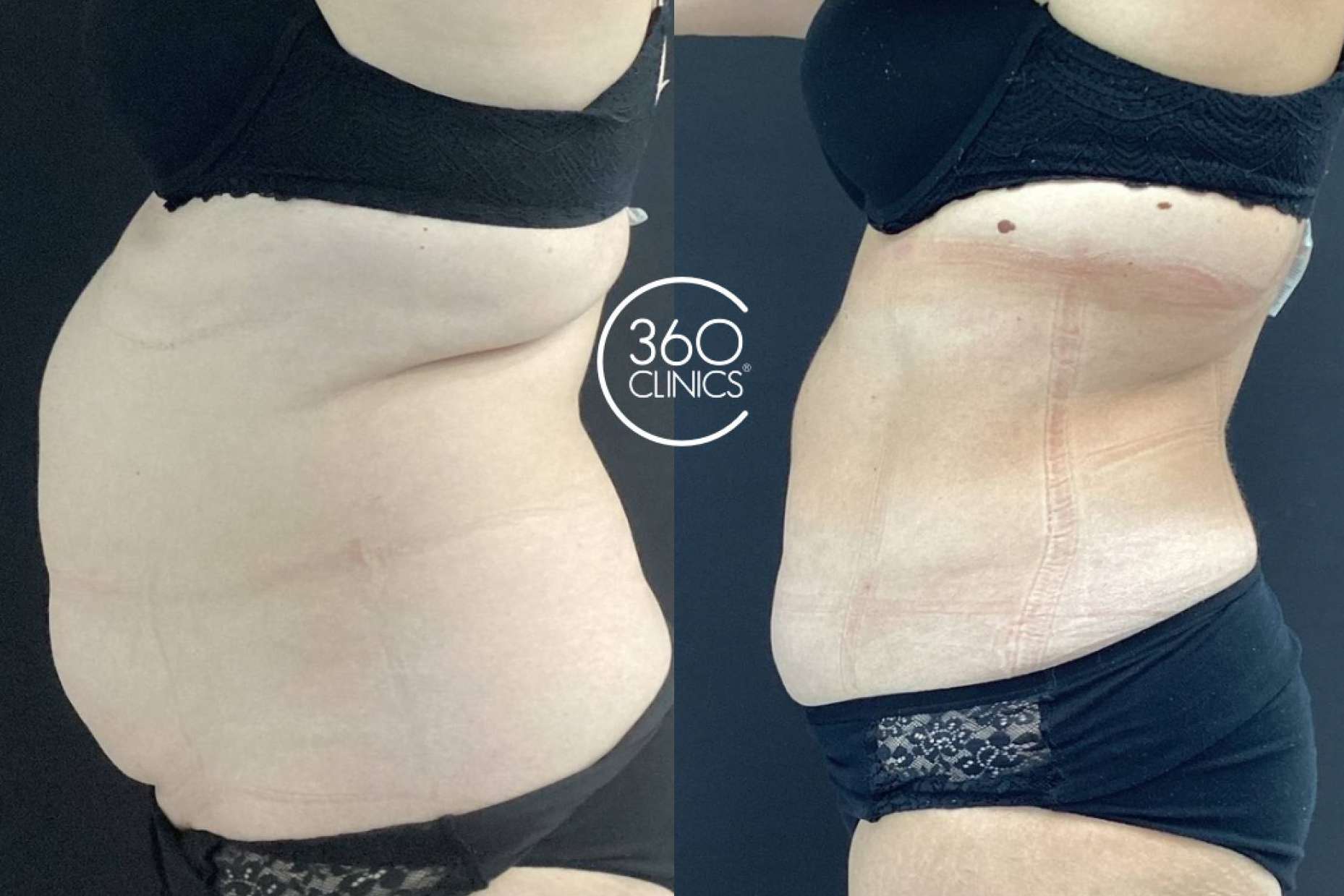 360Clinics Líderes en el tratamiento Lipo Láserfit Medical, revolución en tratamientos corporales sin cirugía