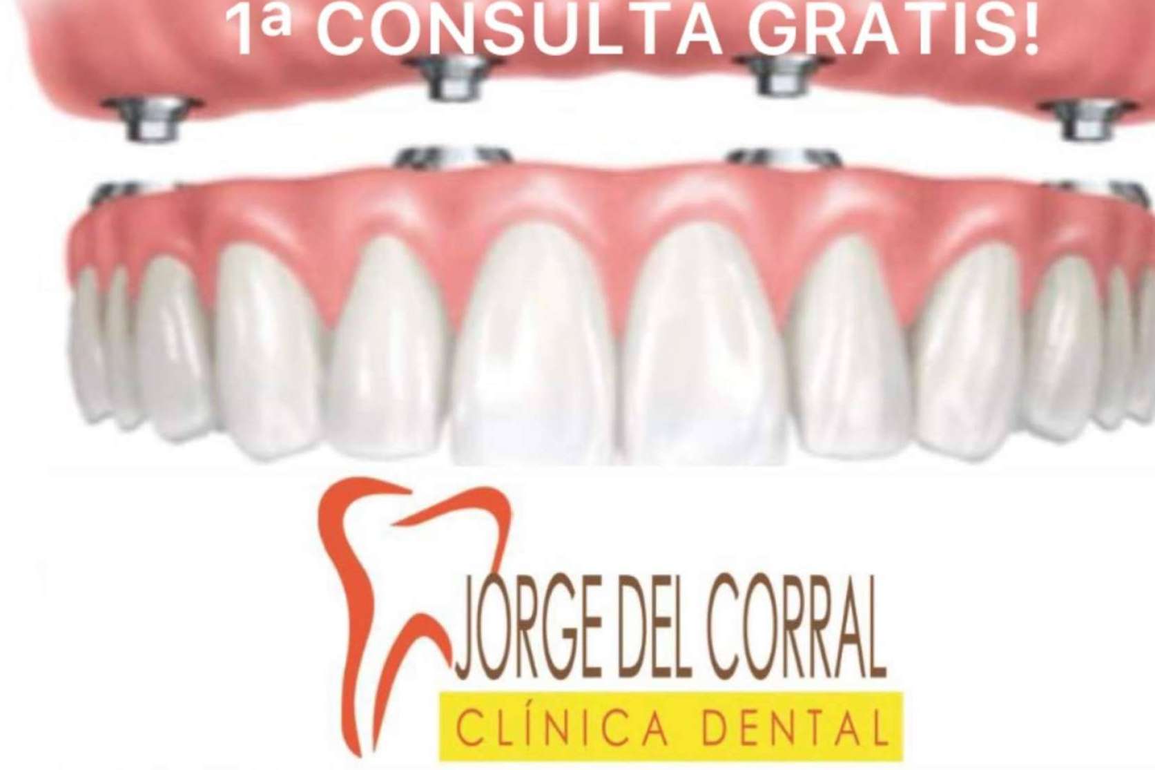Clínica Dental Jorge del Corral, excelencia en implantología dental