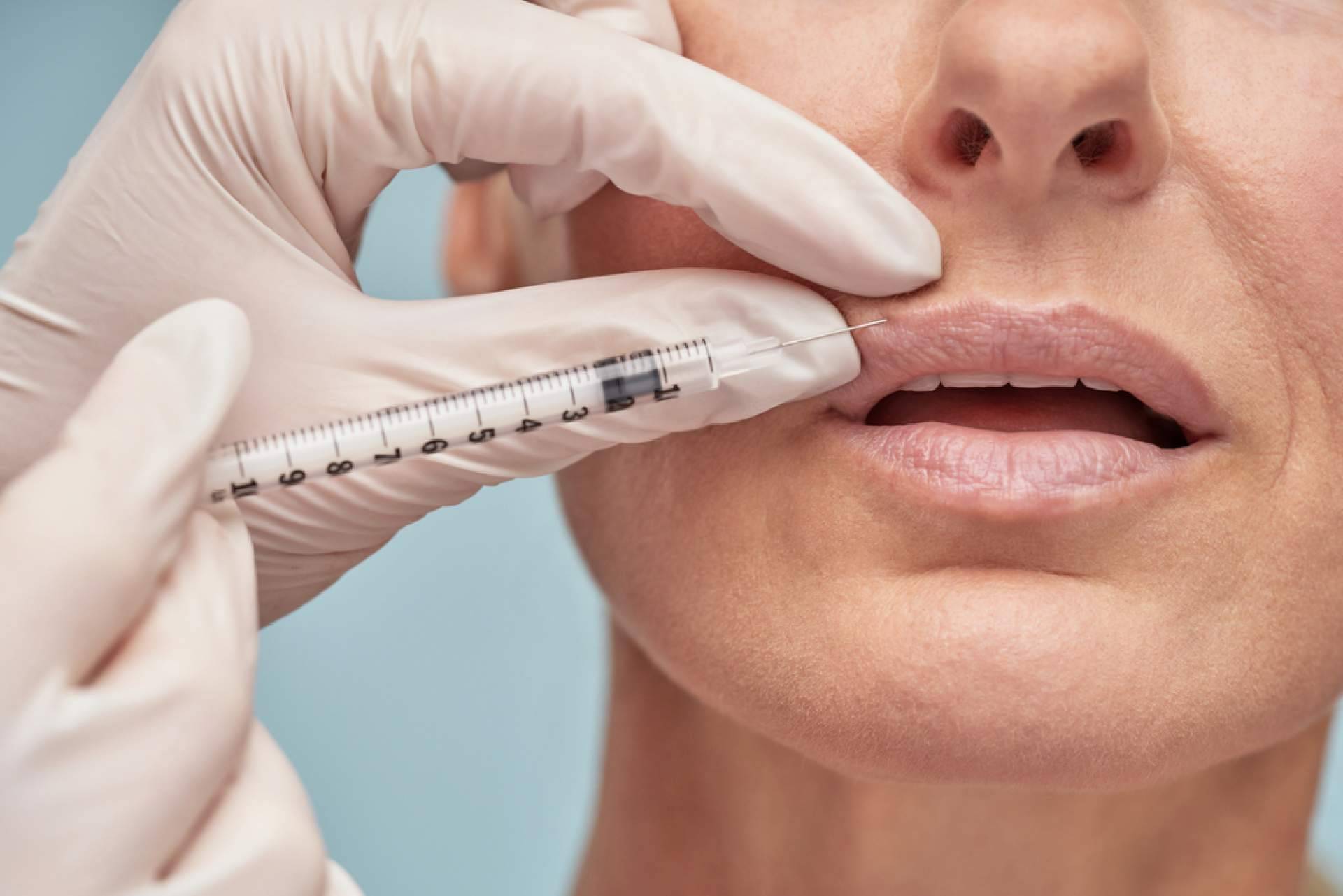 Labios con volumen natural gracias al relleno con ácido hialurónico de Centro Estetica el Pilar