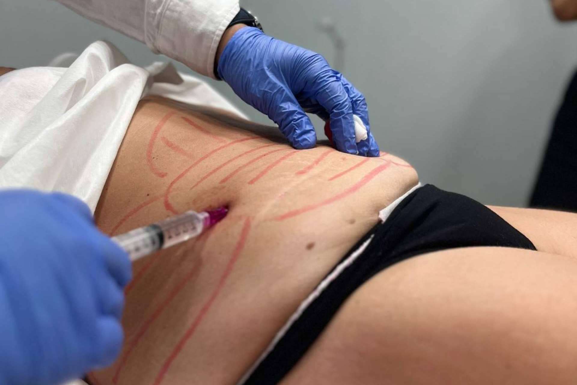 Lipoláser Fit, la propuesta de 360Clinics para una remodelación corporal mínimamente invasiva esta temporada